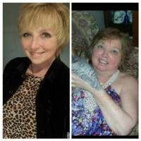 Cushing's Syndrome Adrenal Tumor