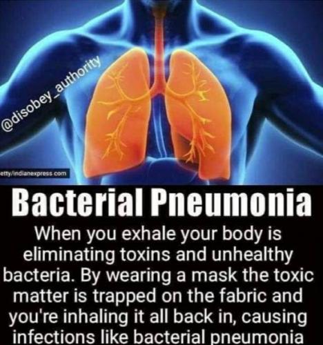bacterial pneumonia