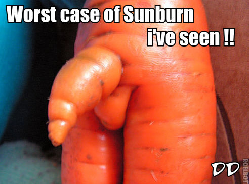dd sunburn