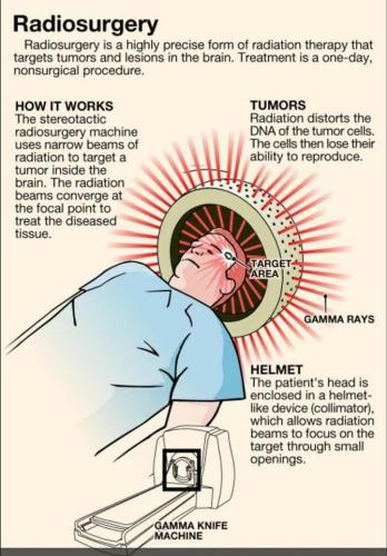 radiosurgery