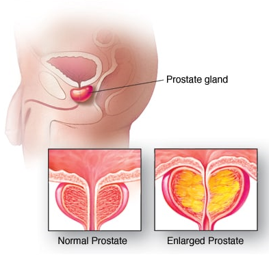 Comparing normal and enlarged prostate glands