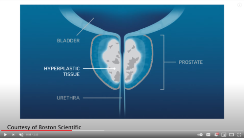 New Fix For Enlarged Prostate Found