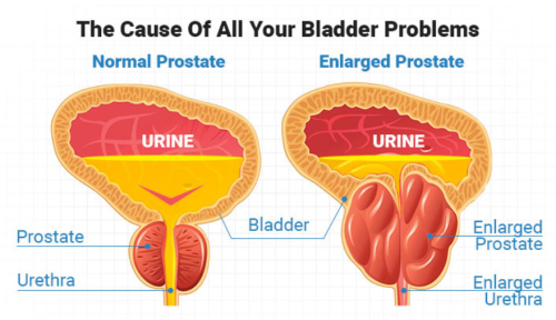 Prostate Problem