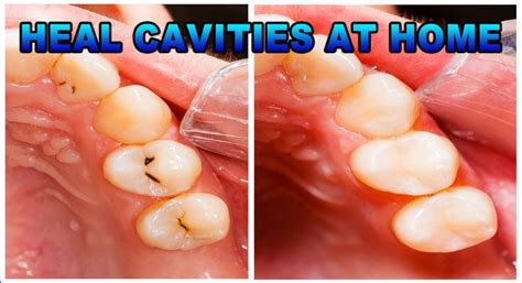 Heal Cavities Naturally Without Going to The Dentist !