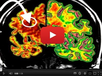 What really happens inside your brain when you have vertigo?