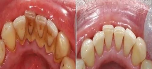 How to remove “PLAQUE” without going to the “DENTIST” Awesome!