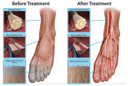 Discover the 7-Step Revolutionary Holistic System Proven to End Chronic Peripheral Neuropathy and Stop Diabetic Nerve Pain In As Little As 24 Hours!