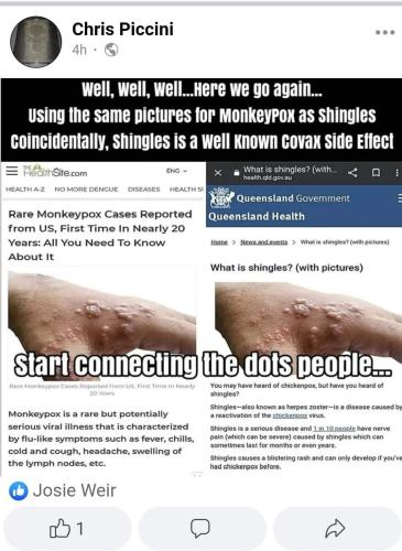 Shingles or pox