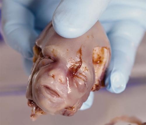 aborted baby 2