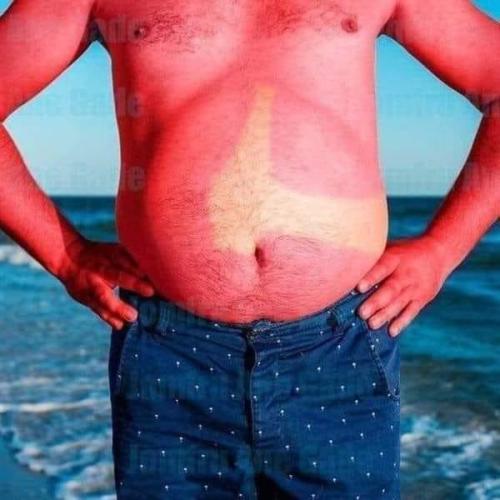 beer sunburn