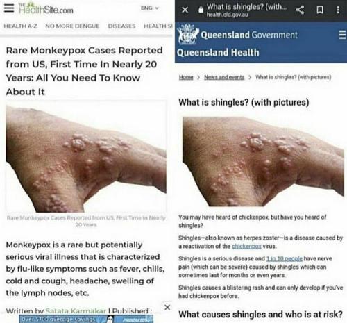 monkeypox39
