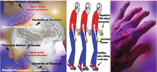 Parkinson's disease (PD) is developed due to the damage of dopaminergic