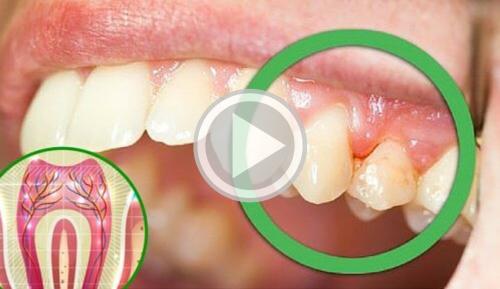 Killer Bacteria Hidden In Your Gums