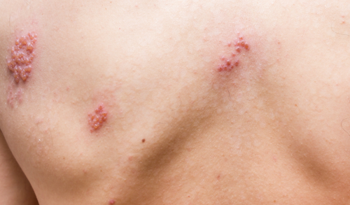 Don't suffer with shingles