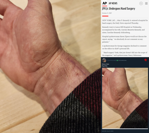 Vincent Kennedy Shows Hand Scar & JFK Jr. Had Hand Surgery October 9, 1997