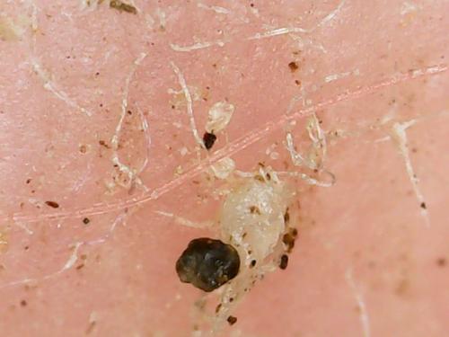 FOOT BOTTOM SHEDDING