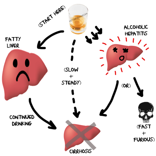 Alcoholic Liver Disease stages