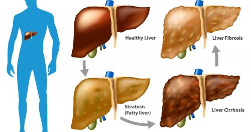 Healthy Liver vs Damaged Liver