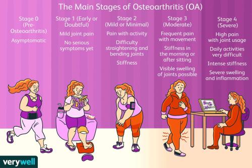 Osteoarthritis Stages