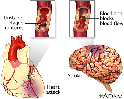 Cholesterol arterial plaque brain heart