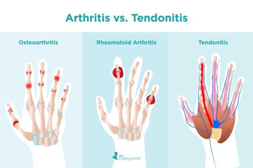 Arthritis vs Tendonitis