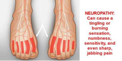 neuropathy pain