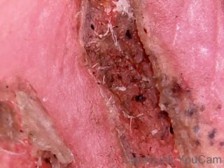 Finger Cut and Nano Patching Scar (2)