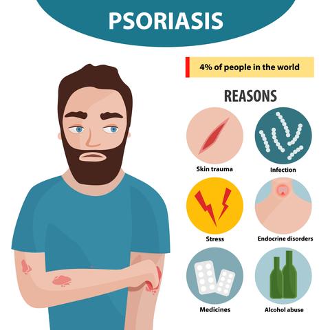 Psoriasis causes