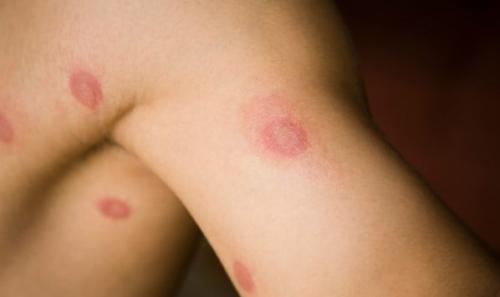 sexually transmitted desaese men