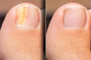 Toenail Fungus vs healthy nail