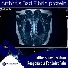 Arthritis Cause - Fibrin dissolved by heal n soothe