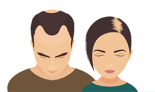 caricature hair loss men women