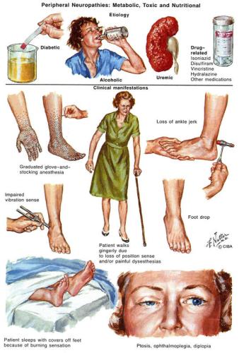 peripheral_neuropathy