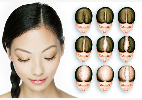 hair loss in women - pattern baldness