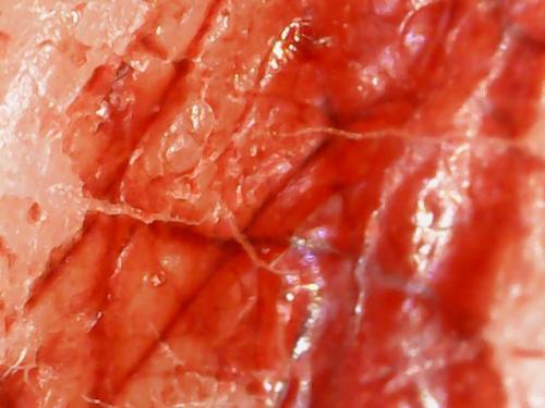 SPINE DRAINAGE AND AIR DRIED RESCABBING (2)