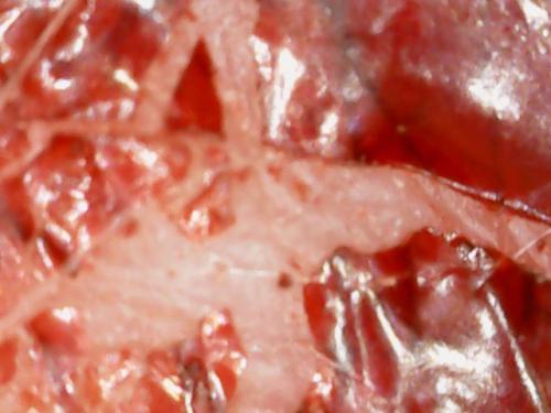 SPINE DRAINAGE AND AIR DRIED RESCABBING (17)