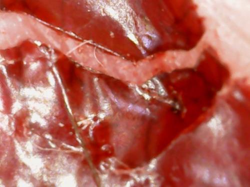 SPINE DRAINAGE AND AIR DRIED RESCABBING (13)