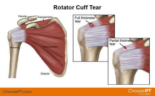 rotator-cuff-tear-illustration_880x550-2495574393