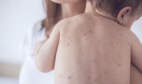 Measles-1024x603