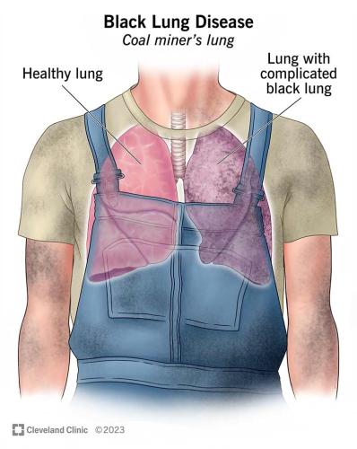 25135-black-lung