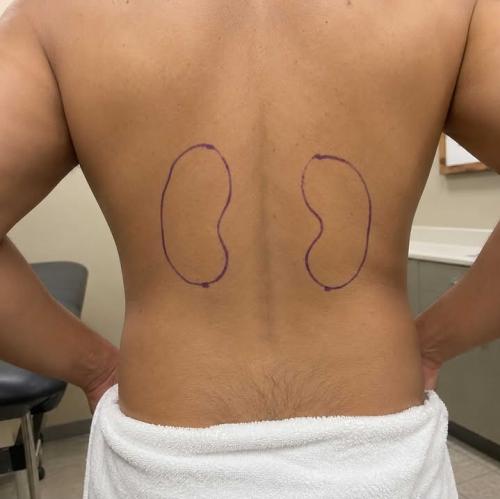 6 Stages of Kidney Failure!