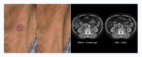 Cancer before and after